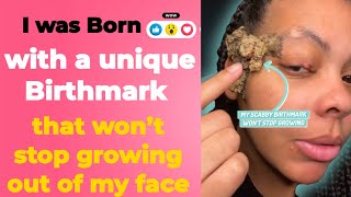 I was born with a unique birthmark that won’t stop growing out of my face