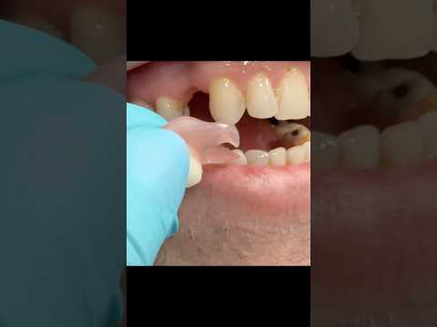 Child Flipper Teeth