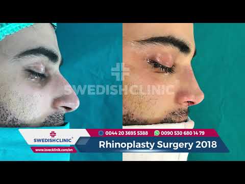 download lagu mp3 mp4 Best Rhinoplasty Surgeon Turkey, download lagu Best Rhinoplasty Surgeon Turkey gratis, unduh video klip Best Rhinoplasty Surgeon Turkey