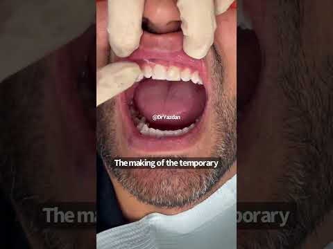 Porcelain veneers procedure | porcelain veneers before and after | porcelain veneers front teeth