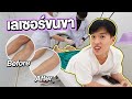 รีวิวเลเซอร์ขนขาครั้งแรก! เทียบชัดๆ Before After | NutApiwich