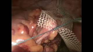 Download Lagu Laparoscopic Rectal Prolapse repair (Rectopexy) by Dr Sandip Banerjee Thumbnail