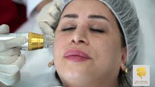 Laser Treatments