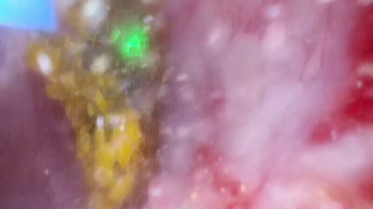 Flexible Ureteroscopy