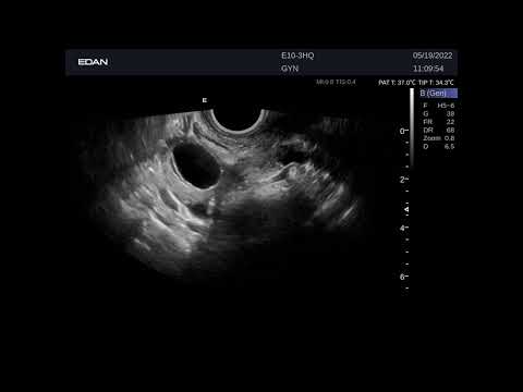 Кинопетли Edan Acclarix LX9 Гинекология