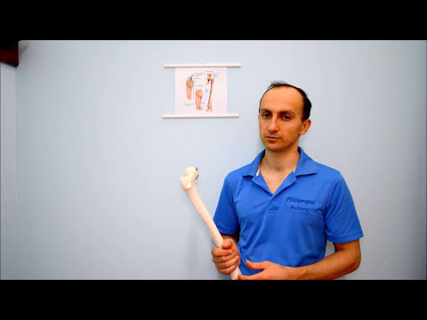 Femur Fracture: Symptoms, Complications and Recovery Times