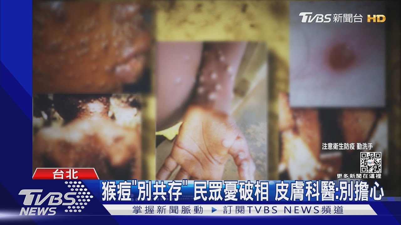 猴痘「別共存」民眾憂破相 皮膚科醫:別擔心