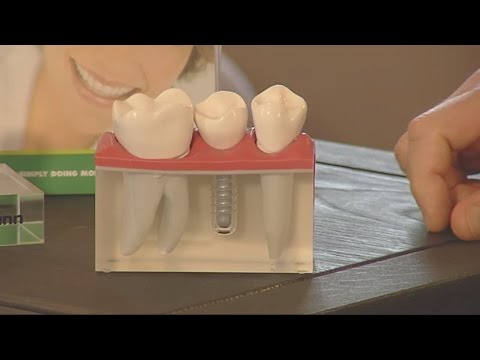 Straumann - Was ist ein Zahnimplantat?