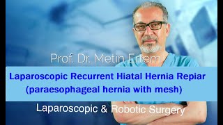 Miniaturka - Laparoscopic Paraesophageal hernia Repair. After sliding hernia repair. Metin Ertem MD.FACS.