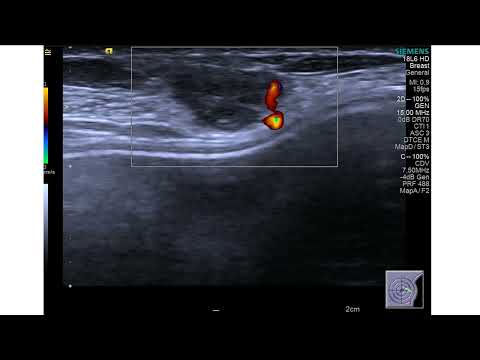 Recidiva muscular de carcinoma mamário após a adenectomia. Biiópsia com agulha semi automática.