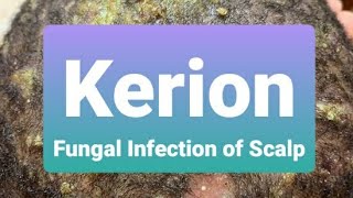 Kerion | Insight and Treatment