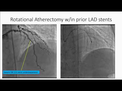 How to Treat Large Vessel Coronary Perforation - Michael Luna, MD