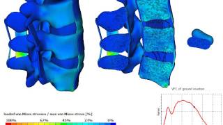 Criterion based simulation of an L5-L3 spine segment (L4 treated with bipedicular kyphoplasty)