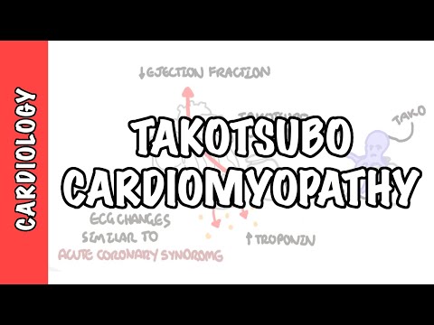 Takotsubo Cardiomyopathy (Broken Heart Syndrome) - Pathophysiology, Diagnosis and Treatment
