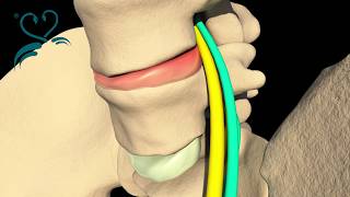 Siyatik Sinir ağrısı nedir ? - Dr. AKŞAN