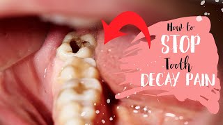 Best Home Remedies For Tooth Decay & Cavities🦷 tooth decay pain (Treatment for a Tooth Cavity)