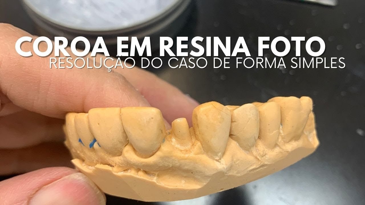 Coroa Em Resina Foto - Resolução de Caso de Forma Simples