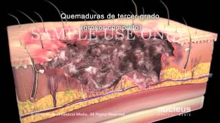 Quemaduras: Clasificación y tratamiento