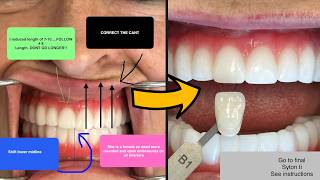 Sophisticated 11-Implant SYTON 7-Star Solution