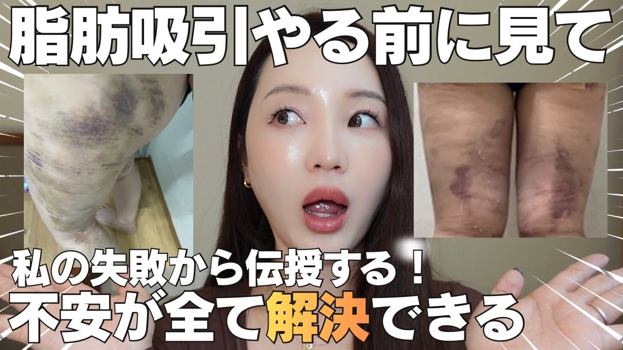 【脂肪吸引】失敗から学ぶ！『確認不足だと詰む』脂肪吸引前後で必須まとめ✍🏻