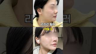 피부 재생 GOAT 리쥬란