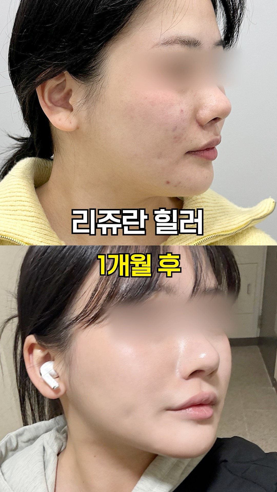 피부 재생 GOAT 리쥬란