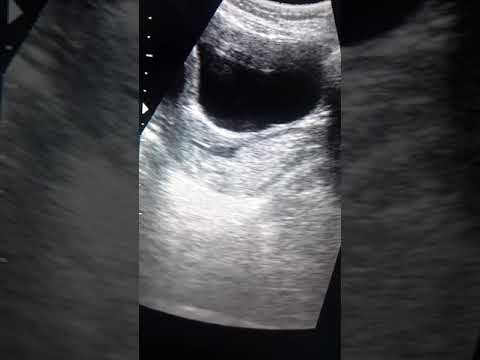Ultrasound video showing rare hematocolpos #