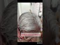 Interesting Case :- Sebaceous Horn in Sebaceous cyst #rare_finding #medicine #interesting