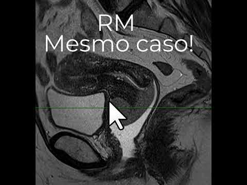 Diferença entre a TC e a RM no estadiamento local do câncer de colo uterino