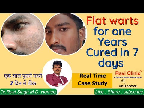 Flat Warts Since one year Cured in 7 Days