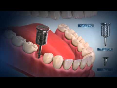 AB Dental Implants - Special Tools