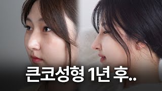 큰코성형 1년 후.. | 무보형물 코성형, 큰코성형, 매부리 교정 | 첫단추 코성형클리닉