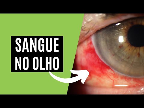 Sangue no Olho ou Hemorragia Subconjuntival