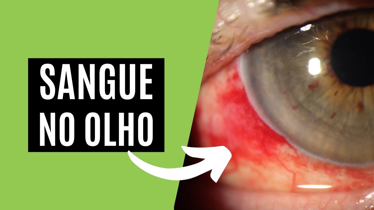 Sangue no Olho ou Hemorragia Subconjuntival