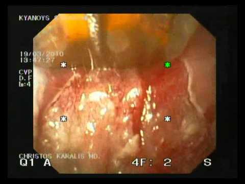 Barrett's Esophagus - Halo 90 Endoscopic Therapy