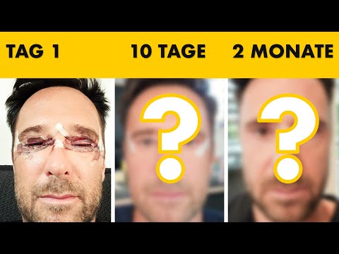 Lidstraffung - Er hat 10 Tage lang jeden Tag ein Foto gemacht | Heilungsverlauf | Dr. Jungwirth