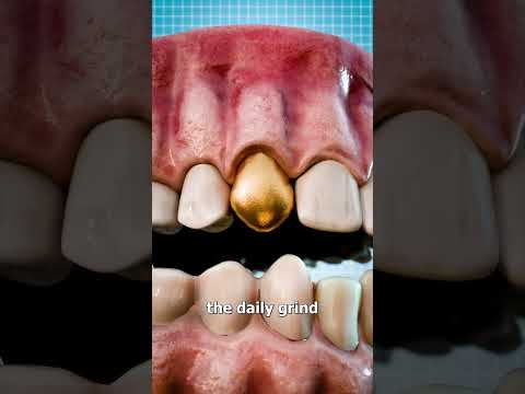 Why Dentists Still Use Gold Teeth ????