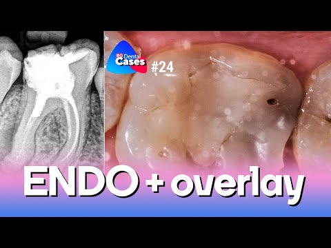 Endodontic Treatment + Overlay - Clinical Case