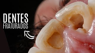 Lentes de contato dentais para dentes quebrados