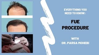 FUE Procedure 4-11 Feat. Dr. Parsa Mohebi