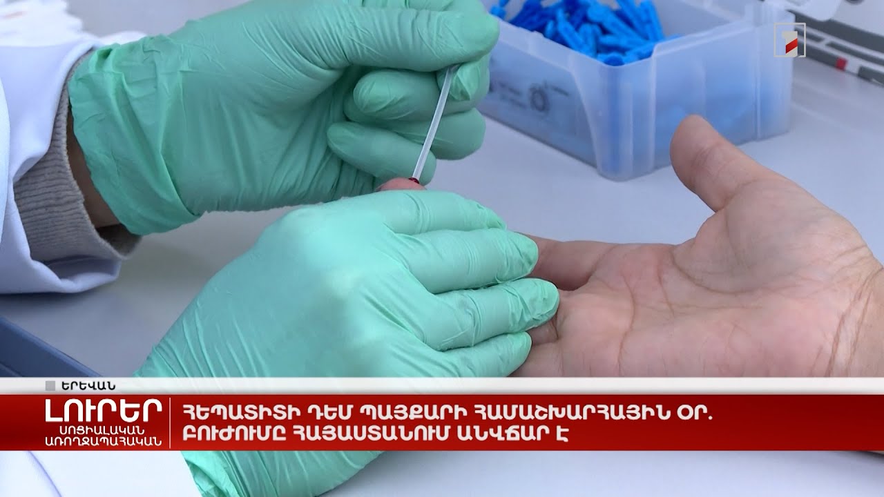 Հեպատիտի դեմ պայքարի համաշխարհային օր. բուժումը Հայաստանում անվճար է