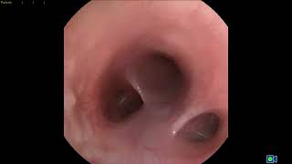 Vidéo Fibroscopie Collapsus Trachéal