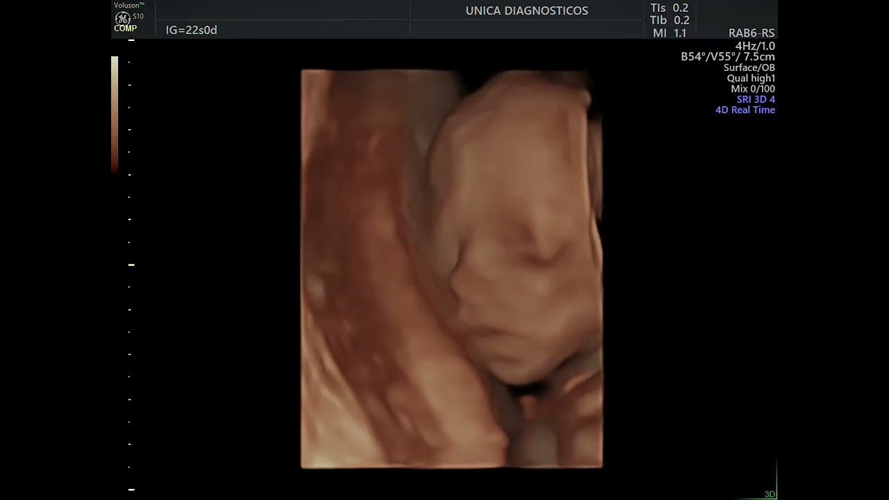 Ultrassom 4D HD Live (22 semanas de gestação)