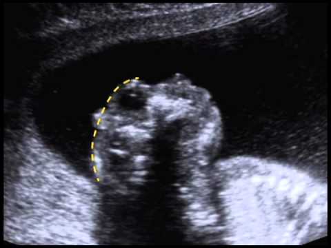 Anencephaly/Acrania (11.11)