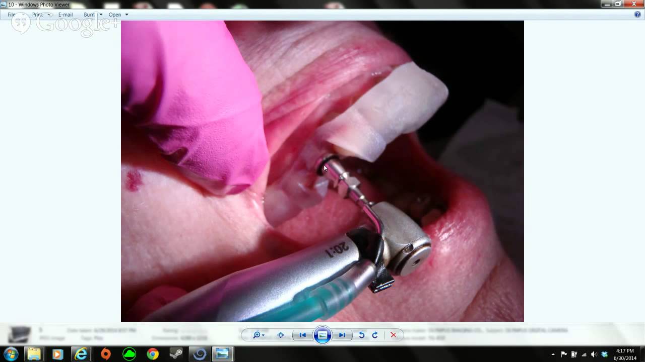 Fabricating Computer Guided Surgical Templates. COMPLETE IN LAB SOLUTION (Directed towards dental...