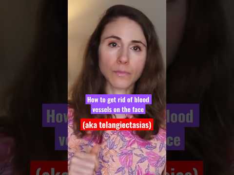 How to get rid of blood vessels on the face #dermatologist