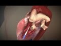 Heart Edwards Sapien Transcatheter Heart Valve With Ascendra Transapical System
