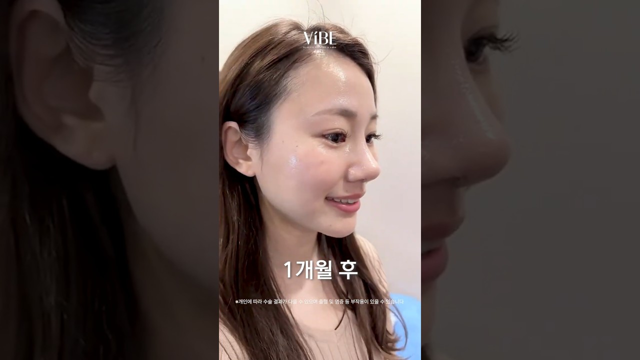 복코&낮은코 → 청순한 반버선코✨ 1개월만에 자연스러운 코수술 전후 비교