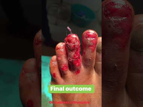 Compound toe fracture