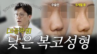 밋밋한 콧대에 입체감을! 복코와 낮은 콧대 개선한 고2 여자학생 코성형 전후 5개월 케이스리뷰 (실리콘 + 비중격 연골)